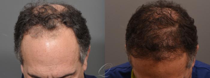 Male Crown Hair Restoration Case 1001698 Before & After Front | Serving Rochester, Syracuse & Buffalo, NY | Quatela Center for Plastic Surgery