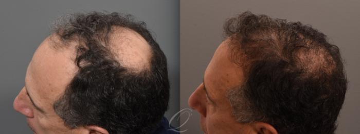 Male Hairline and Central Density Hair Restoration Case 1001698 Before & After Left Side | Serving Rochester, Syracuse & Buffalo, NY | Quatela Center for Plastic Surgery
