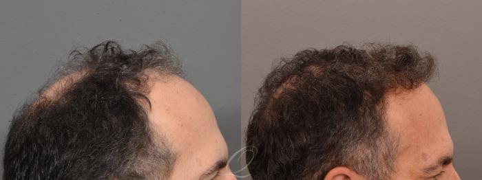 FUT Case 1001698 Before & After Right Side | Serving Rochester, Syracuse & Buffalo, NY | Quatela Center for Plastic Surgery
