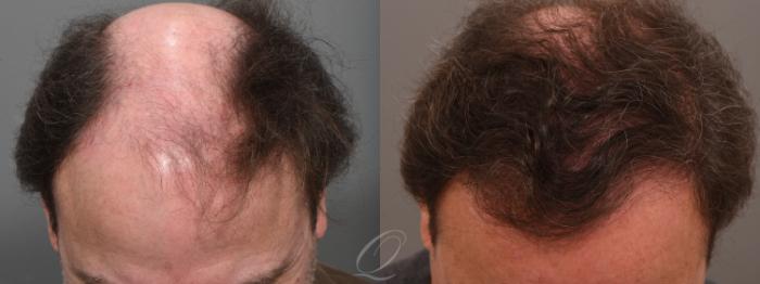 FUT Case 1001699 Before & After Front | Serving Rochester, Syracuse & Buffalo, NY | Quatela Center for Plastic Surgery