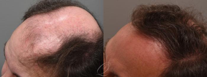 Finasteride, Minoxidil, and 82F/M Case 1001699 Before & After Left Side | Serving Rochester, Syracuse & Buffalo, NY | Quatela Center for Plastic Surgery