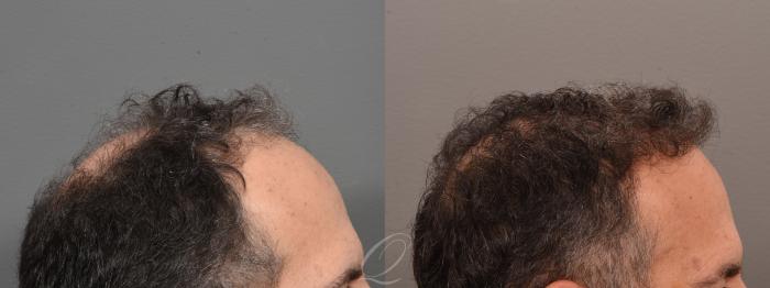 FUT Case 1001699 Before & After Right Side | Serving Rochester, Syracuse & Buffalo, NY | Quatela Center for Plastic Surgery