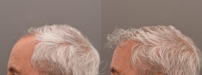 FUT Case 1001700 Before & After Left Side | Serving Rochester, Syracuse & Buffalo, NY | Quatela Center for Plastic Surgery