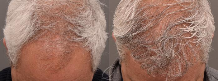 FUT Case 1001700 Before & After Top View | Serving Rochester, Syracuse & Buffalo, NY | Quatela Center for Plastic Surgery