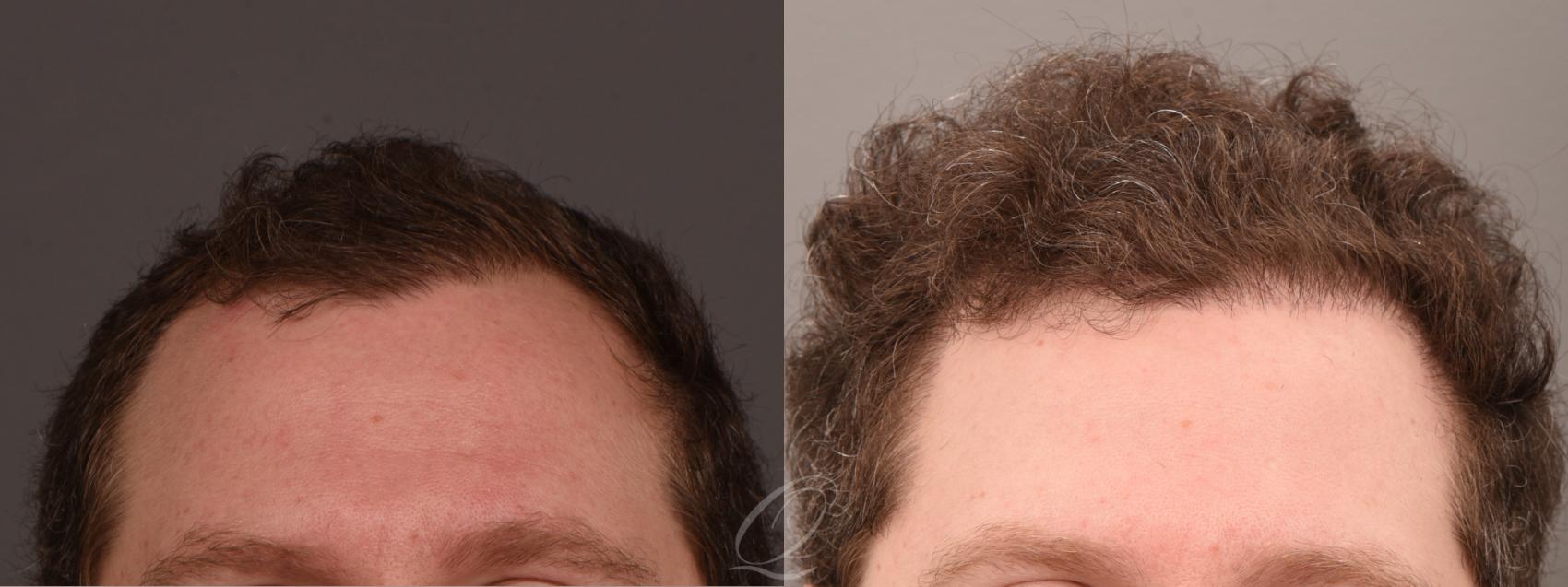 FUT Case 1001712 Before & After Front | Serving Rochester, Syracuse & Buffalo, NY | Quatela Center for Plastic Surgery