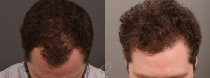FUT Case 1001712 Before & After Head down | Serving Rochester, Syracuse & Buffalo, NY | Quatela Center for Plastic Surgery