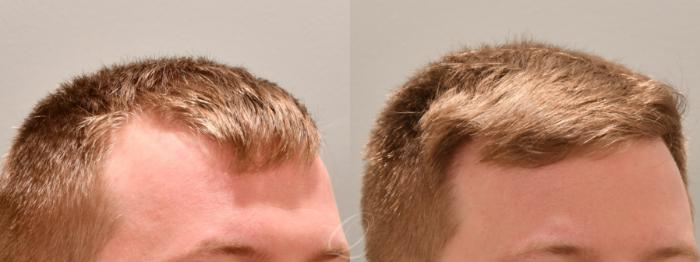 Before & After FUT Case 1001778 Right Oblique View in Rochester, Buffalo, & Syracuse, NY