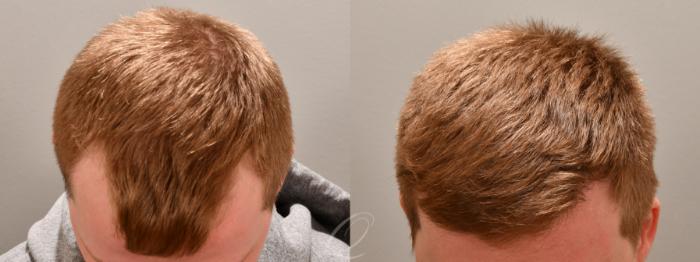 FUT Case 1001778 Before & After Top View | Serving Rochester, Syracuse & Buffalo, NY | Quatela Center for Plastic Surgery