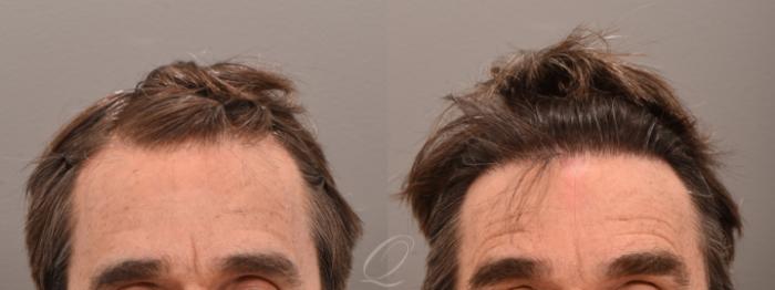 FUT Case 1001779 Before & After Front | Serving Rochester, Syracuse & Buffalo, NY | Quatela Center for Plastic Surgery