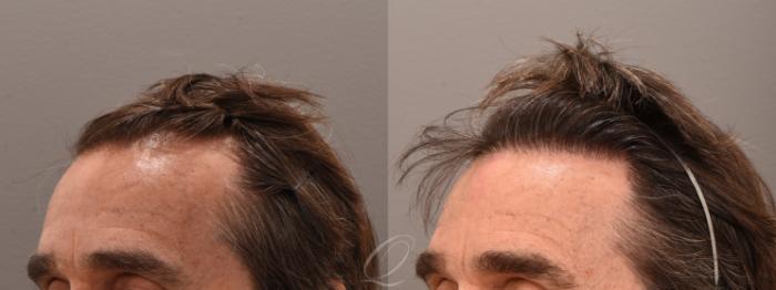 FUT Case 1001779 Before & After Left Oblique | Serving Rochester, Syracuse & Buffalo, NY | Quatela Center for Plastic Surgery