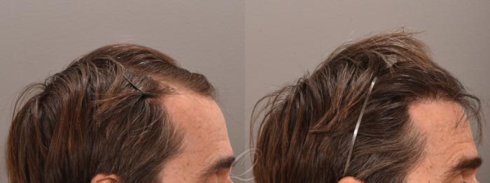 Before & After FUT Case 1001779 Right Side View in Rochester, Buffalo, & Syracuse, NY