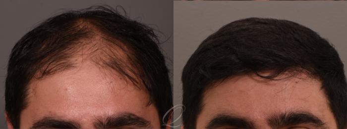 Before & After FUT Case 1001811 Front View in Rochester, Buffalo, & Syracuse, NY