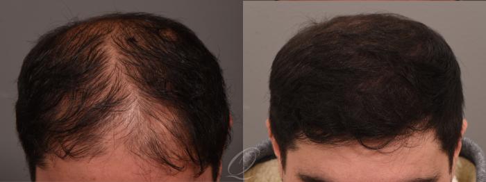 Before & After FUT Case 1001811 Top View in Rochester, Buffalo, & Syracuse, NY