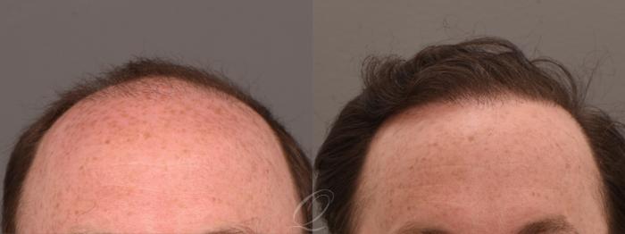 Before & After PRP Injections Case 1001812 Front View in Rochester, Buffalo, & Syracuse, NY