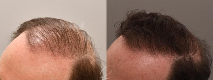 Before & After PRP Injections Case 1001812 Left Side View in Rochester, Buffalo, & Syracuse, NY