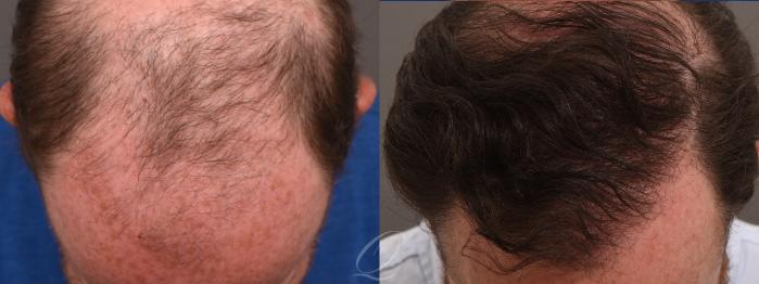 Before & After PRP Injections Case 1001812 Top of Head  View in Rochester, Buffalo, & Syracuse, NY