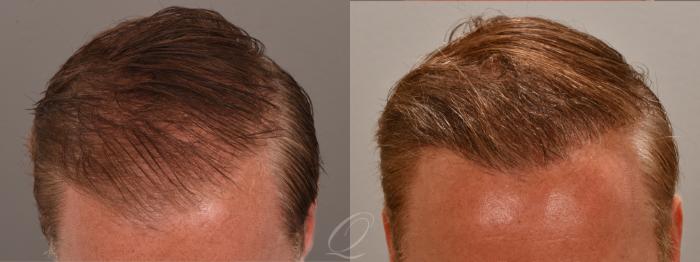 Before & After FUT Case 1001813 TOP OF HEAD  View in Rochester, Buffalo, & Syracuse, NY