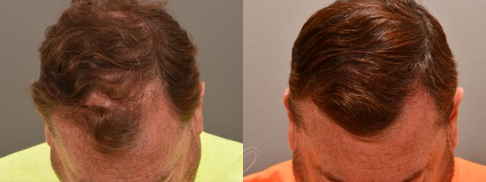 Before & After PRP Injections Case 1001814 Front View in Rochester, Buffalo, & Syracuse, NY