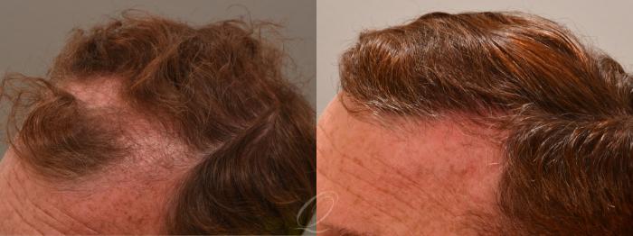 Before & After FUT Case 1001814 Right Side View in Rochester, Buffalo, & Syracuse, NY