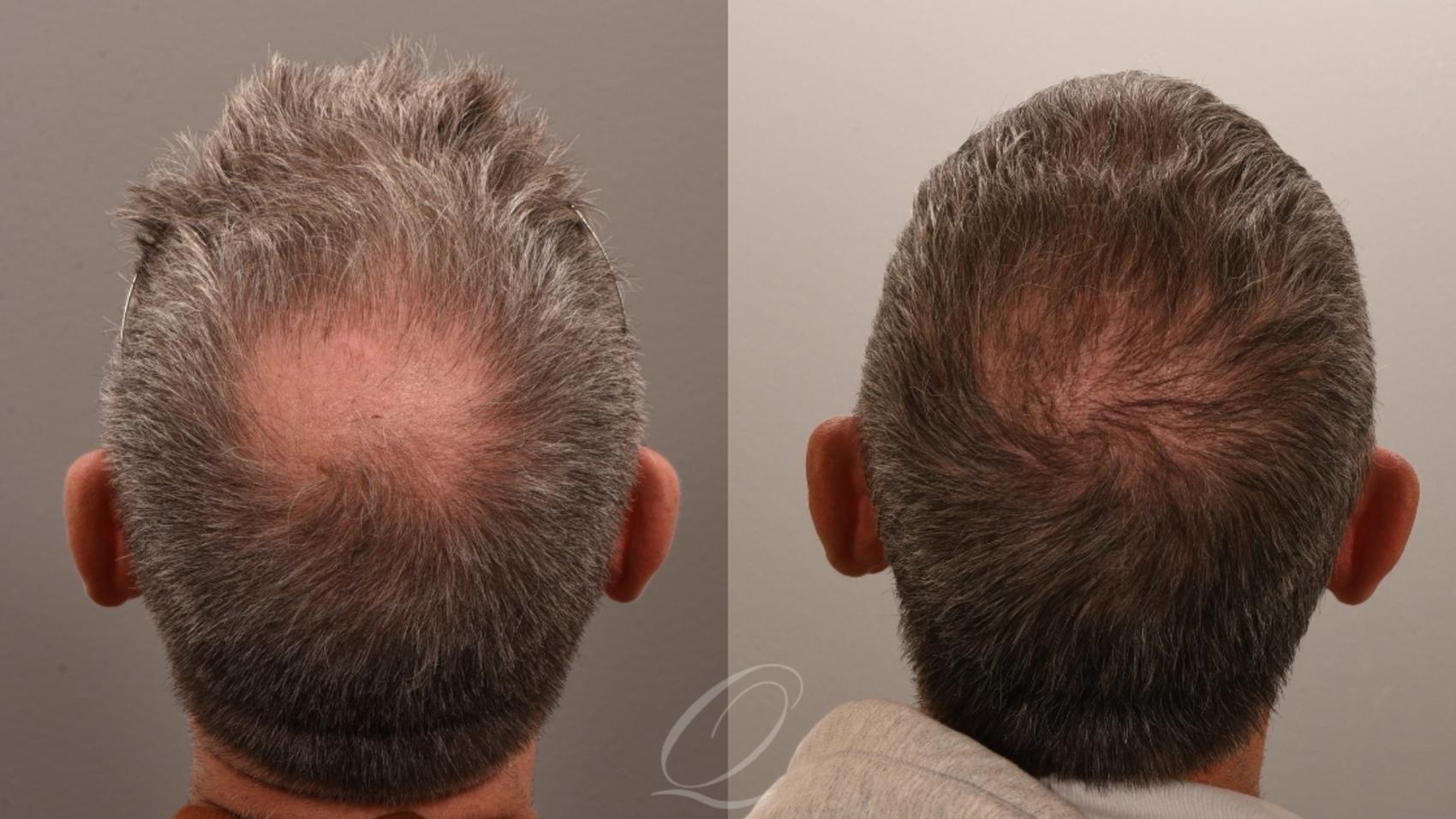 FUT Case 1001842 Before & After Back | Serving Rochester, Syracuse & Buffalo, NY | Quatela Center for Plastic Surgery