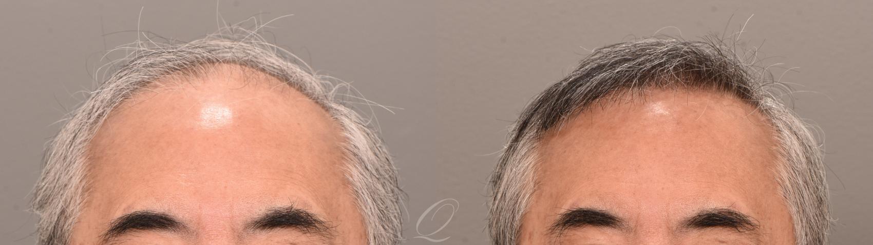 Male Hairline and Central Density Hair Restoration Case 1001873 Before & After front 2  | Serving Rochester, Syracuse & Buffalo, NY | Quatela Center for Plastic Surgery