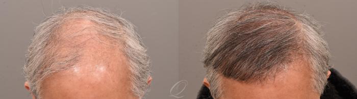Male Hairline and Central Density Hair Restoration Case 1001873 Before & After Front | Serving Rochester, Syracuse & Buffalo, NY | Quatela Center for Plastic Surgery