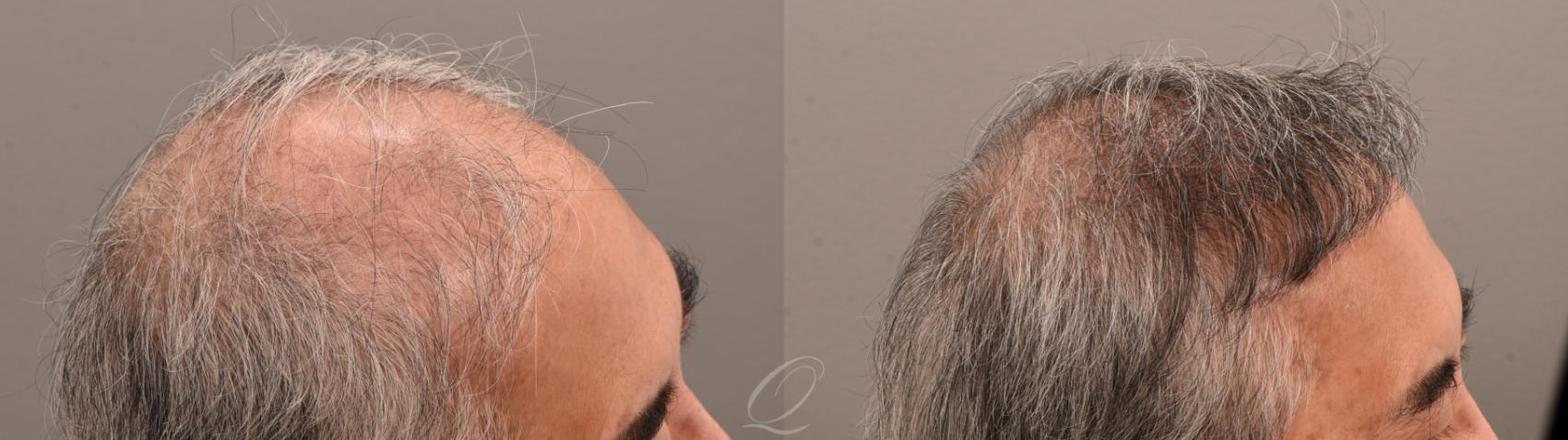 Male Hairline and Central Density Hair Restoration Case 1001873 Before & After Left Side | Serving Rochester, Syracuse & Buffalo, NY | Quatela Center for Plastic Surgery