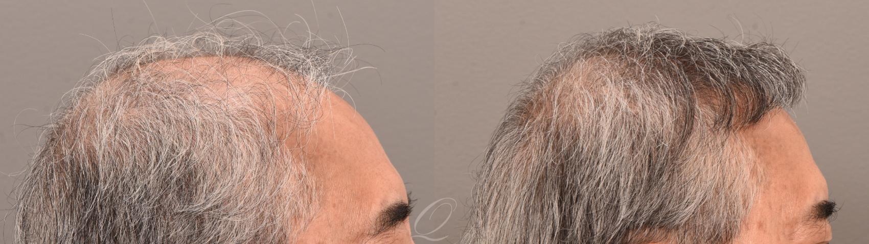 Male Hairline and Central Density Hair Restoration Case 1001873 Before & After Right Side | Serving Rochester, Syracuse & Buffalo, NY | Quatela Center for Plastic Surgery