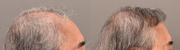 Male Hairline and Central Density Hair Restoration Case 1001873 Before & After Right Side | Serving Rochester, Syracuse & Buffalo, NY | Quatela Center for Plastic Surgery