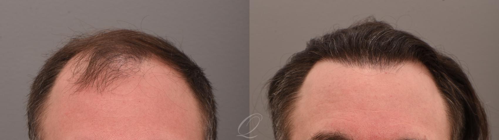 FUT Case 1001884 Before & After Front | Serving Rochester, Syracuse & Buffalo, NY | Quatela Center for Plastic Surgery