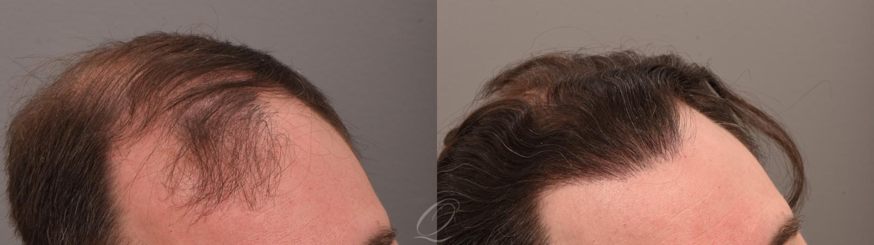 FUT Case 1001884 Before & After left 2  | Serving Rochester, Syracuse & Buffalo, NY | Quatela Center for Plastic Surgery