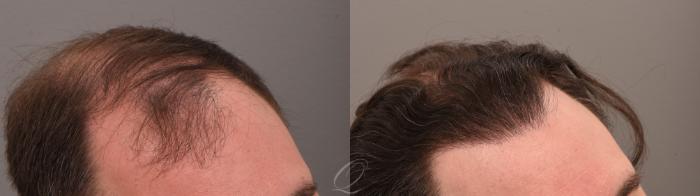 FUT Case 1001884 Before & After left 2  | Serving Rochester, Syracuse & Buffalo, NY | Quatela Center for Plastic Surgery