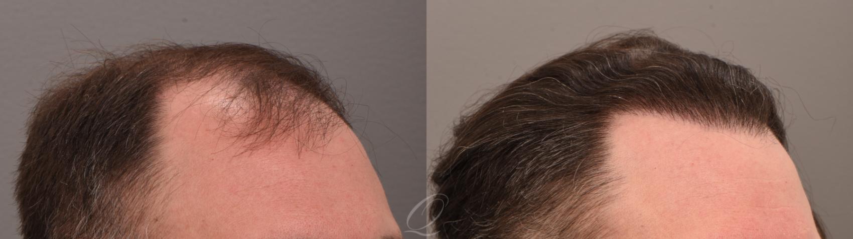 FUT Case 1001884 Before & After Left Side | Serving Rochester, Syracuse & Buffalo, NY | Quatela Center for Plastic Surgery