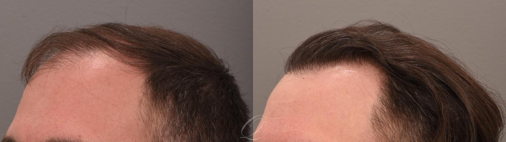 FUT Case 1001884 Before & After right 2  | Serving Rochester, Syracuse & Buffalo, NY | Quatela Center for Plastic Surgery
