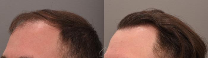 FUT Case 1001884 Before & After right 2  | Serving Rochester, Syracuse & Buffalo, NY | Quatela Center for Plastic Surgery