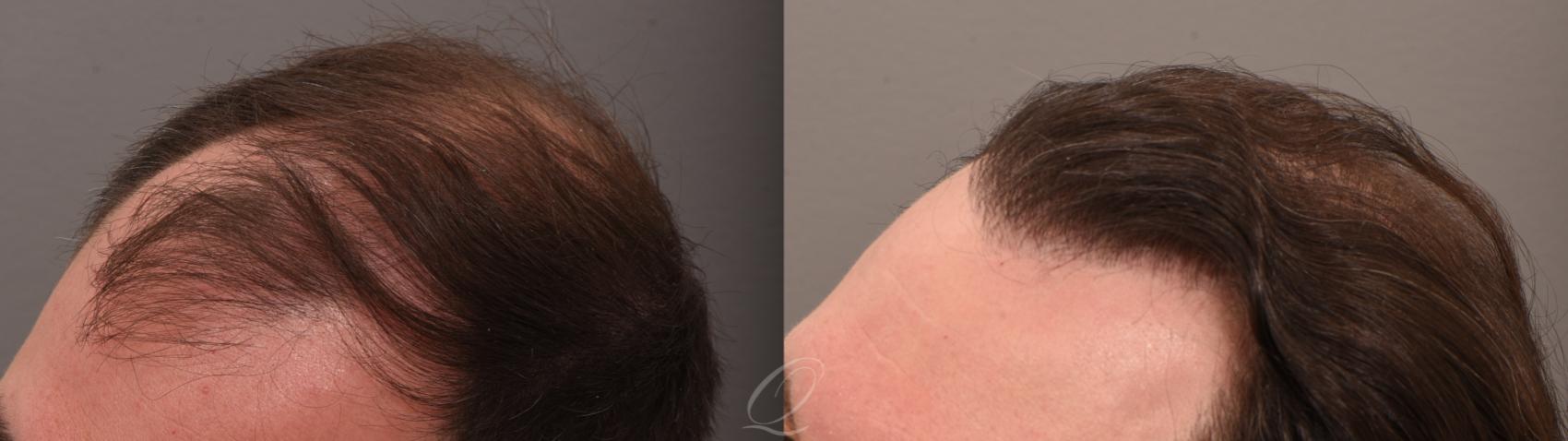 FUT Case 1001884 Before & After Right Side | Serving Rochester, Syracuse & Buffalo, NY | Quatela Center for Plastic Surgery