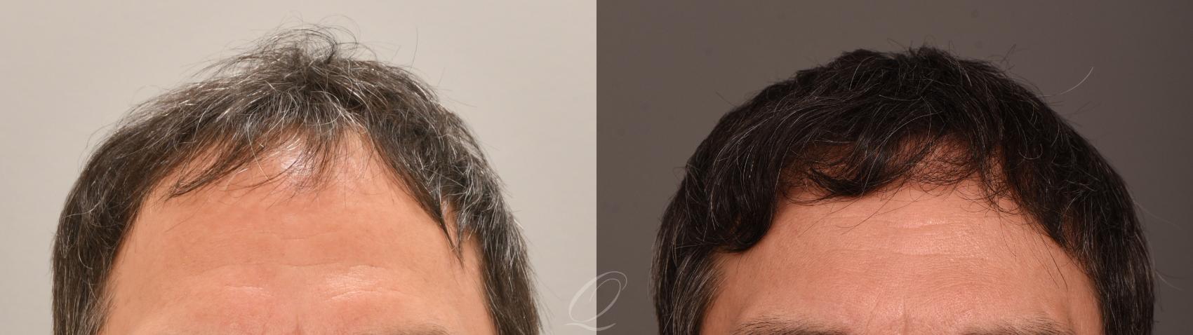 FUT Case 1001885 Before & After Front | Serving Rochester, Syracuse & Buffalo, NY | Quatela Center for Plastic Surgery