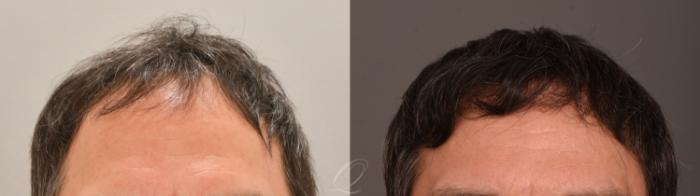 FUT Case 1001885 Before & After Front | Serving Rochester, Syracuse & Buffalo, NY | Quatela Center for Plastic Surgery