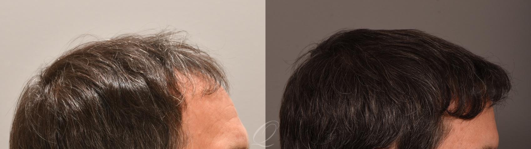 FUT Case 1001885 Before & After Left Side | Serving Rochester, Syracuse & Buffalo, NY | Quatela Center for Plastic Surgery