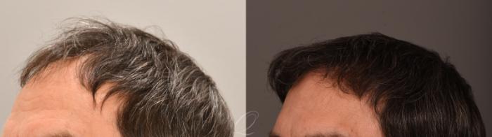 FUT Case 1001885 Before & After Right Side | Serving Rochester, Syracuse & Buffalo, NY | Quatela Center for Plastic Surgery