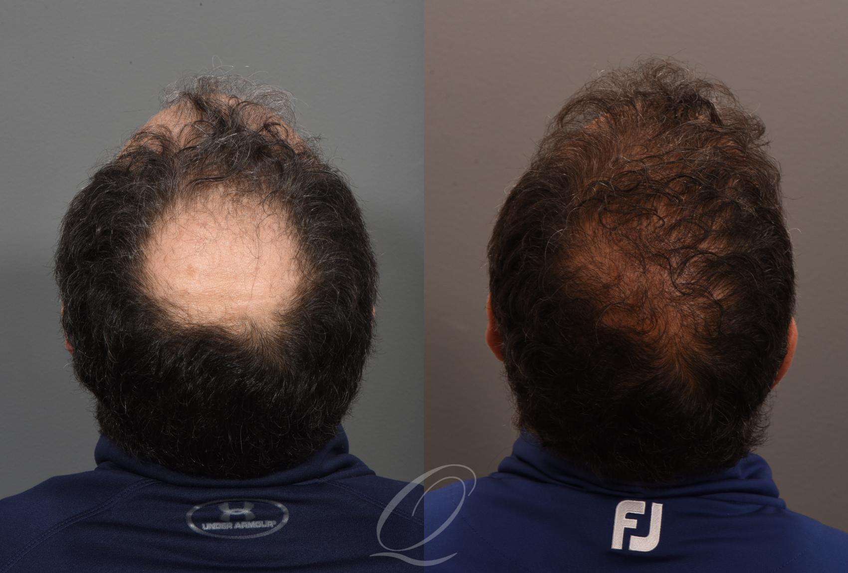 FUT Case 1001886 Before & After Back | Serving Rochester, Syracuse & Buffalo, NY | Quatela Center for Plastic Surgery
