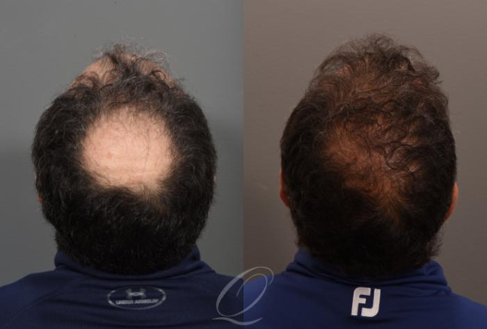FUT Case 1001886 Before & After Back | Serving Rochester, Syracuse & Buffalo, NY | Quatela Center for Plastic Surgery