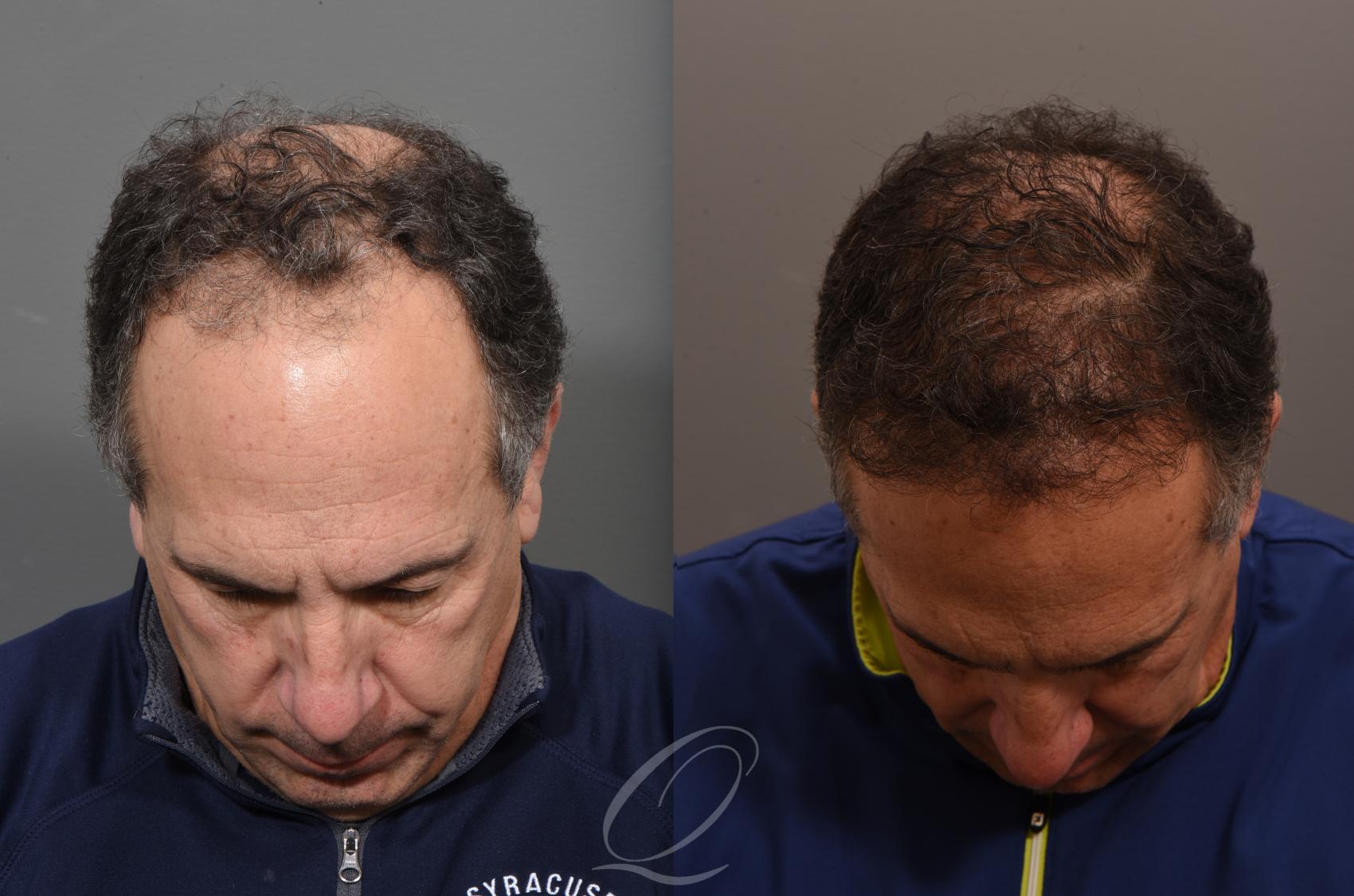 FUT Case 1001886 Before & After Front | Serving Rochester, Syracuse & Buffalo, NY | Quatela Center for Plastic Surgery