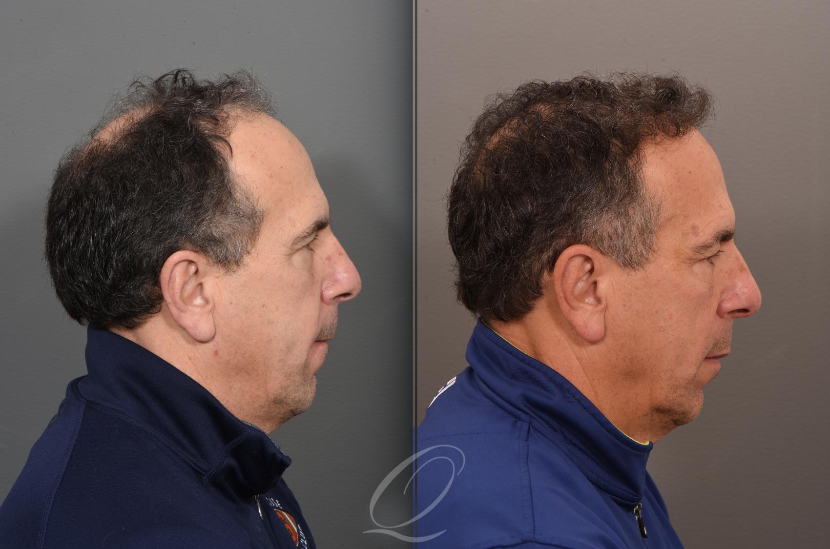 FUT Case 1001886 Before & After Left Side | Serving Rochester, Syracuse & Buffalo, NY | Quatela Center for Plastic Surgery