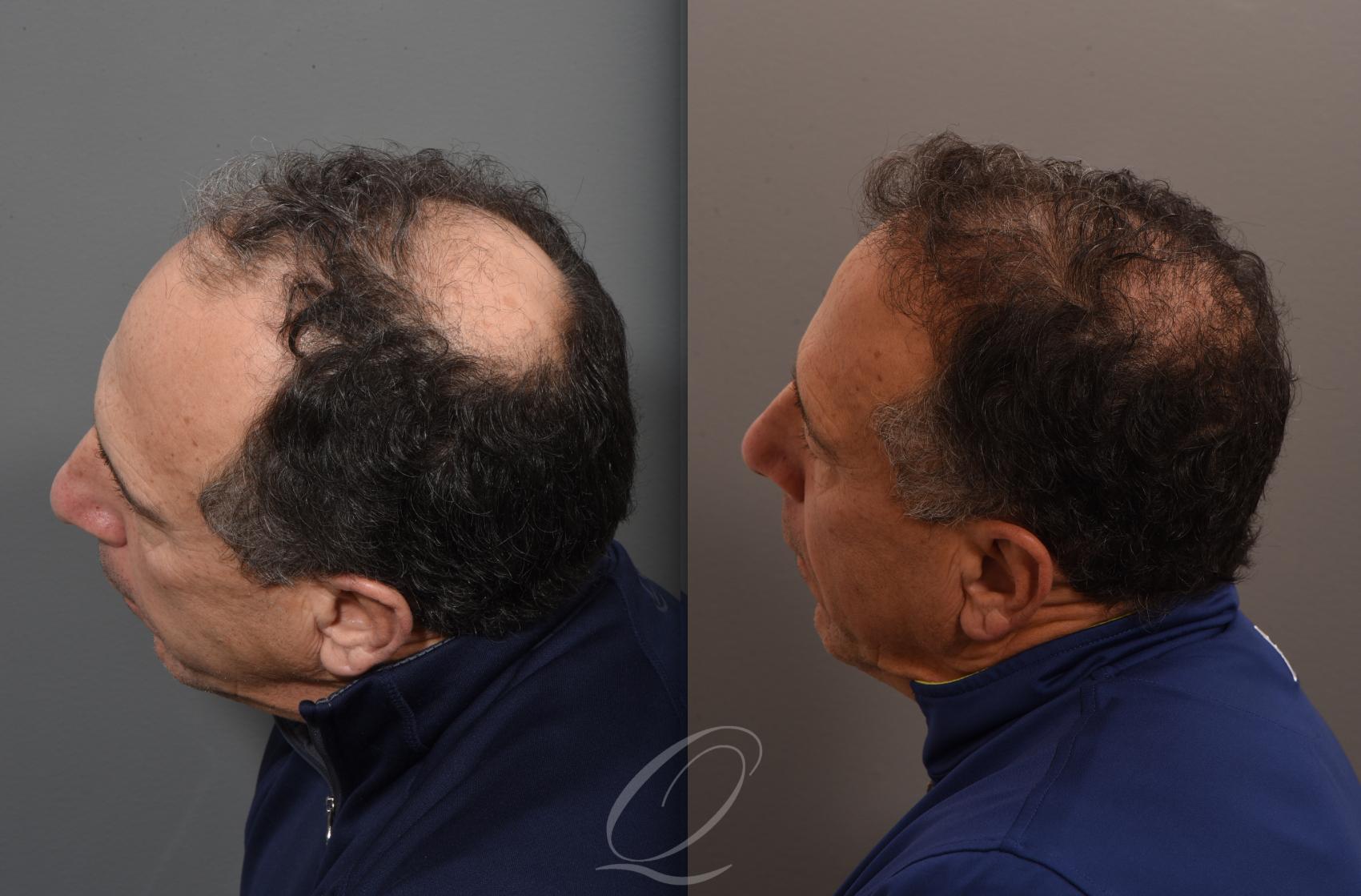 FUT Case 1001886 Before & After Right Side | Serving Rochester, Syracuse & Buffalo, NY | Quatela Center for Plastic Surgery