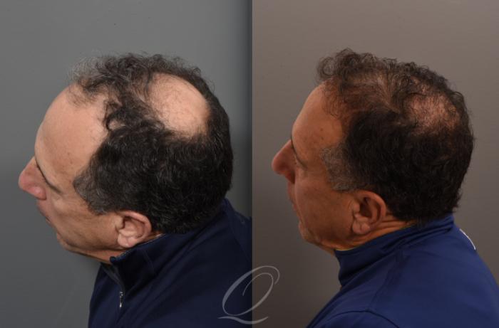FUT Case 1001886 Before & After Right Side | Serving Rochester, Syracuse & Buffalo, NY | Quatela Center for Plastic Surgery