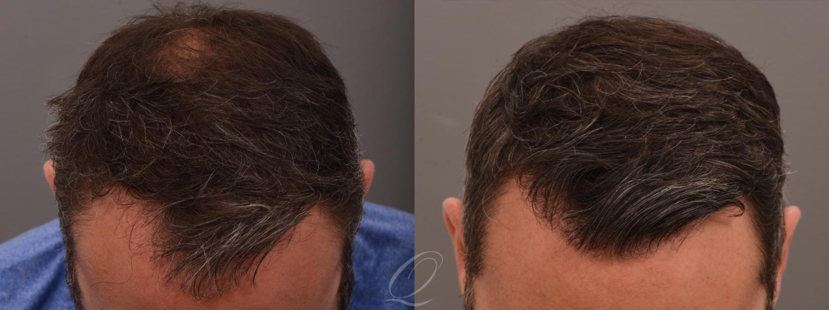 FUT Case 1001887 Before & After front 2  | Serving Rochester, Syracuse & Buffalo, NY | Quatela Center for Plastic Surgery