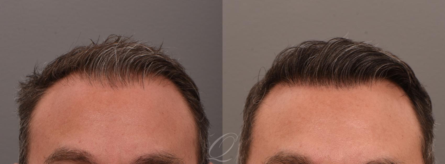 FUT Case 1001887 Before & After Front | Serving Rochester, Syracuse & Buffalo, NY | Quatela Center for Plastic Surgery
