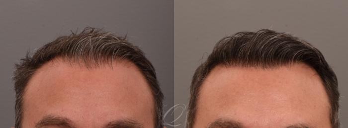 FUT Case 1001887 Before & After Front | Serving Rochester, Syracuse & Buffalo, NY | Quatela Center for Plastic Surgery