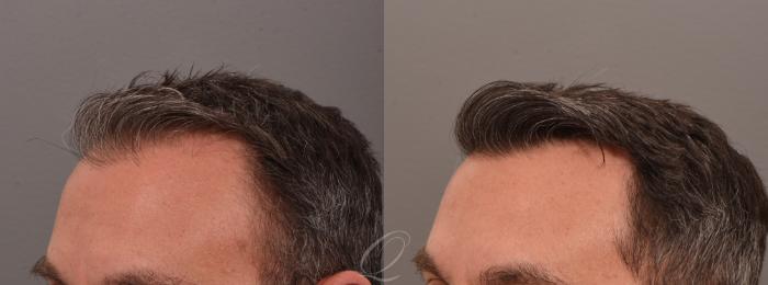FUT Case 1001887 Before & After right 2  | Serving Rochester, Syracuse & Buffalo, NY | Quatela Center for Plastic Surgery